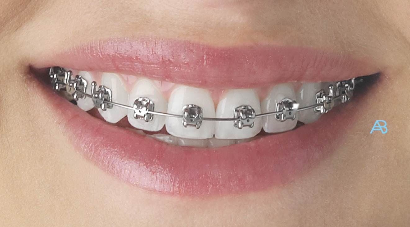 orthodontic braces