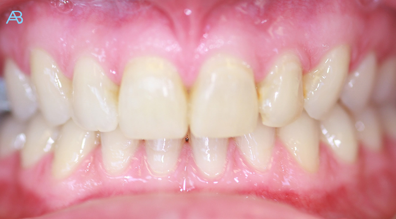 Braces Ace Braces O'Regan Orthodontics Teeth Straightening Ireland