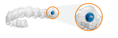 blue dot indicators for Invisalign teens