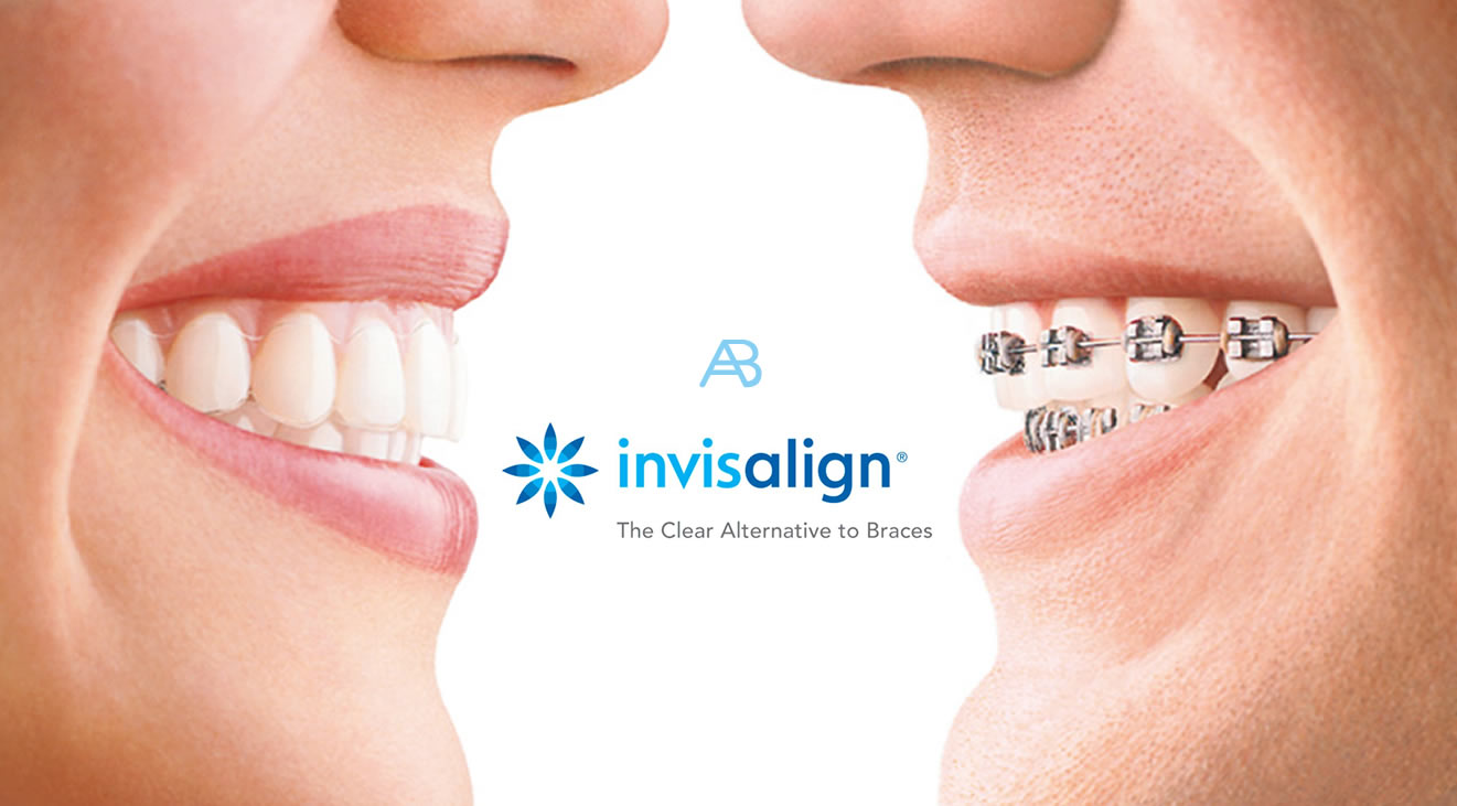 Braces Troy NY  Malsch Orthodontics Invisalign