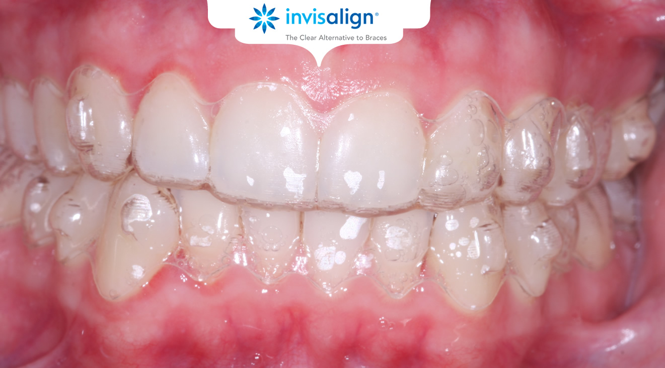 https://www.acebraces.ie/img/invisalign3.jpg