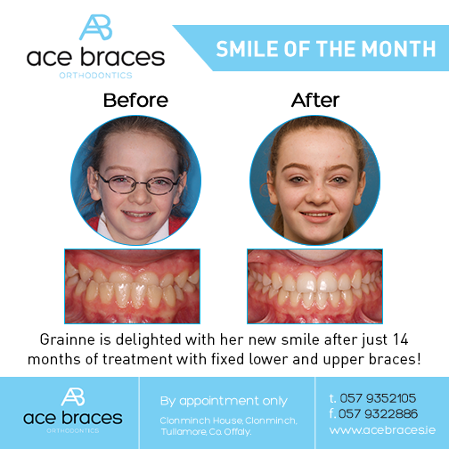 braces in ireland best orthodontist
